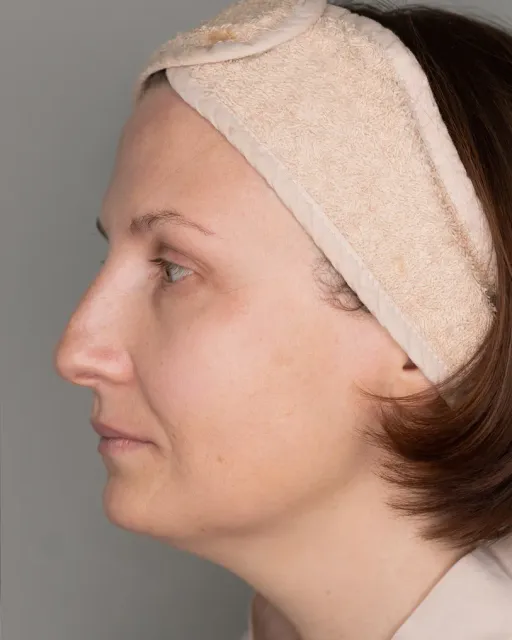 3D rejuvenation Fotona