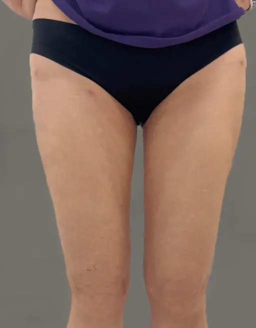 Thigh liposuction