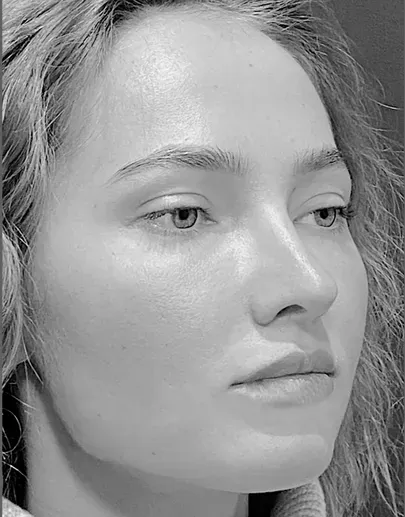 Secondary rhinoplasty