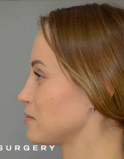 Rhinoplasty