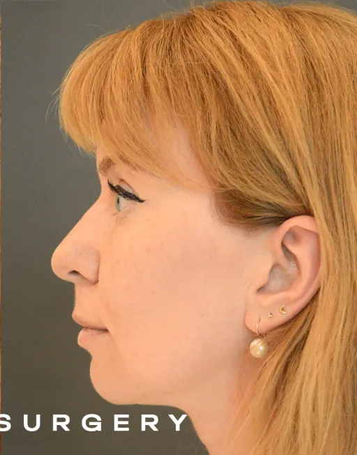 Endoscopic Suspension of the Upper Two Thirds of the Face with Deep Detachment DMAS