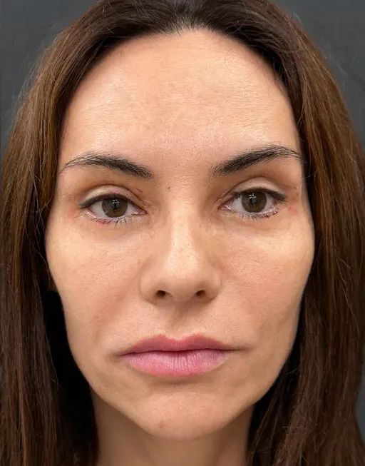 Blefaroplasty