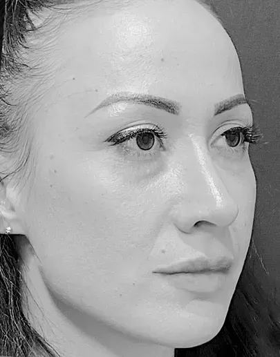 Secondary rhinoplasty