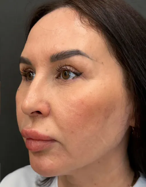 Skin Tyte infrared thermolift