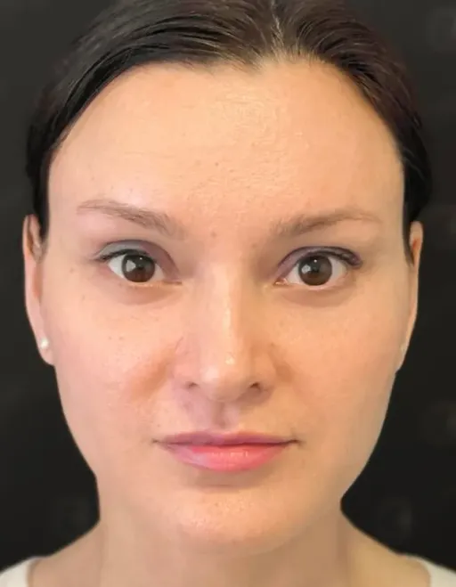 Periorbitoplasty