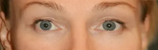 Upper blepharoplasty