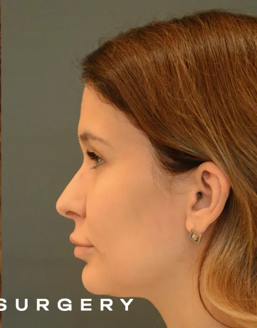 Endoscopic upper third face suspension