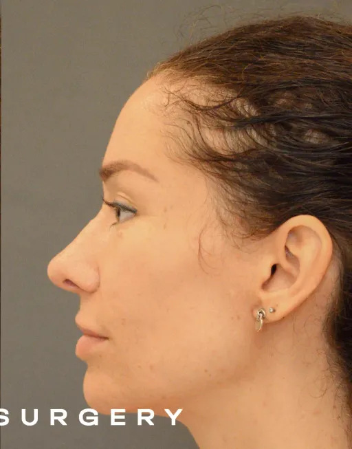 Endoscopic upper third face suspension