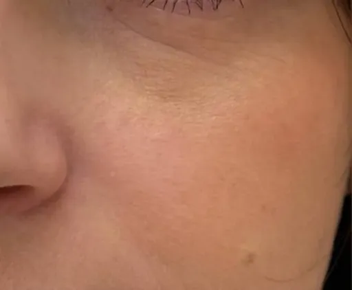 Treatment of skin defects VBEAM
