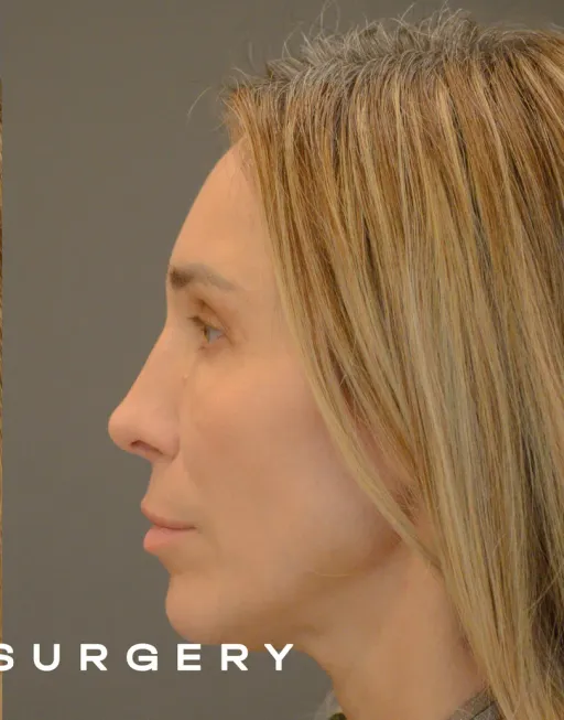 Endoscopic Suspension of the Upper Two Thirds of the Face with Deep Detachment DMAS