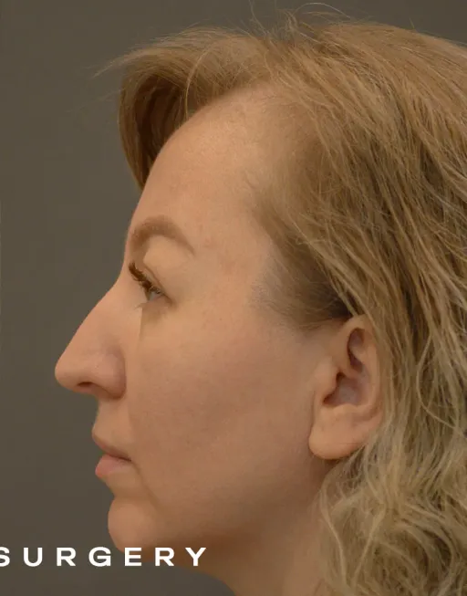 Endoscopic upper third face suspension