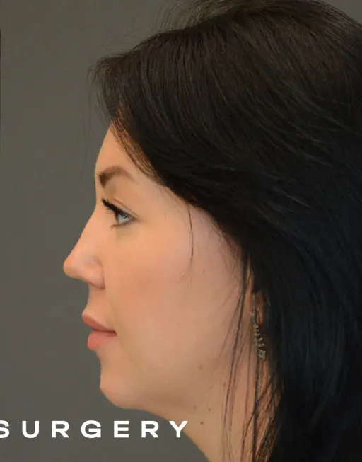 Endoscopic Suspension of the Upper Two Thirds of the Face with Deep Detachment DMAS