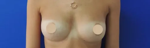 Breast augmentation