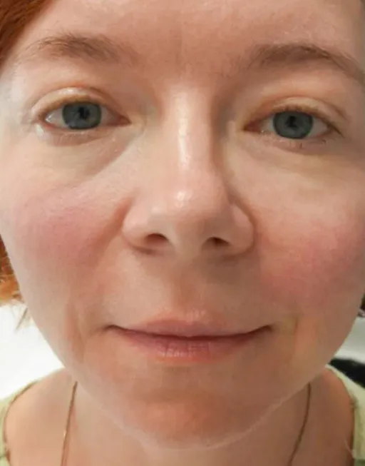 Botulin therapy