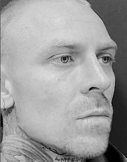 Rhinoplasty