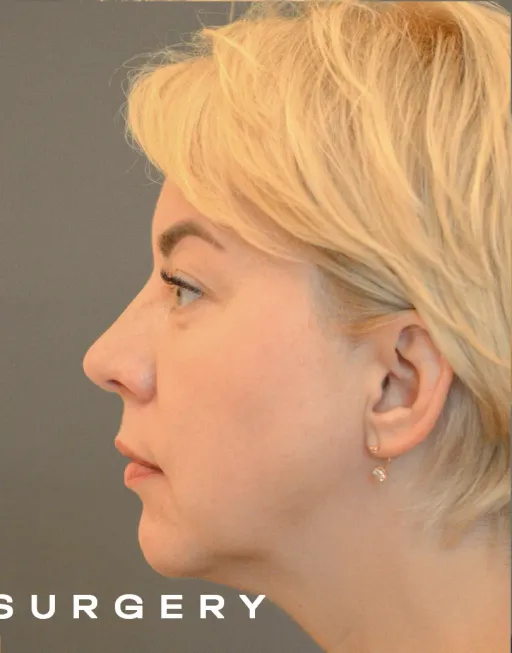 Periorbitoplasty