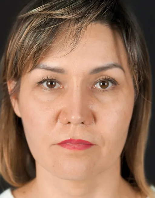 Piezo rhinoplasty