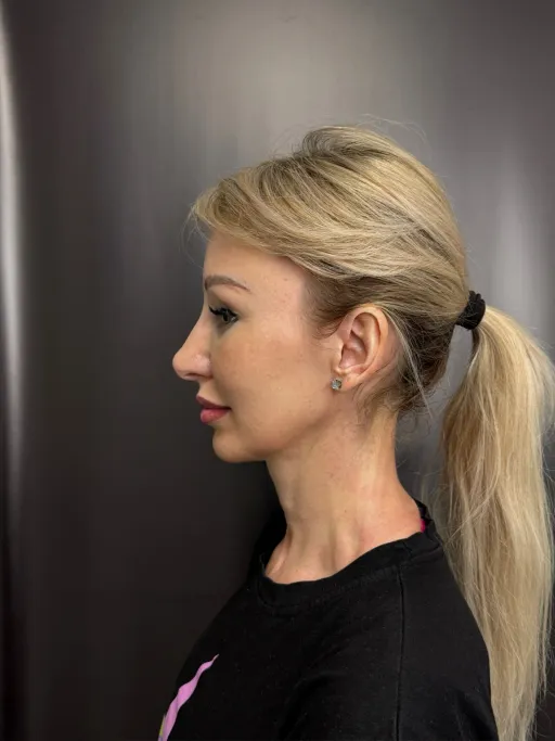 Blefaroplasty