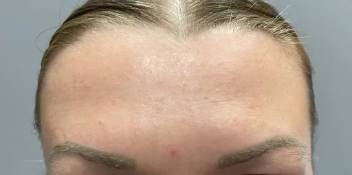 Botulin therapy