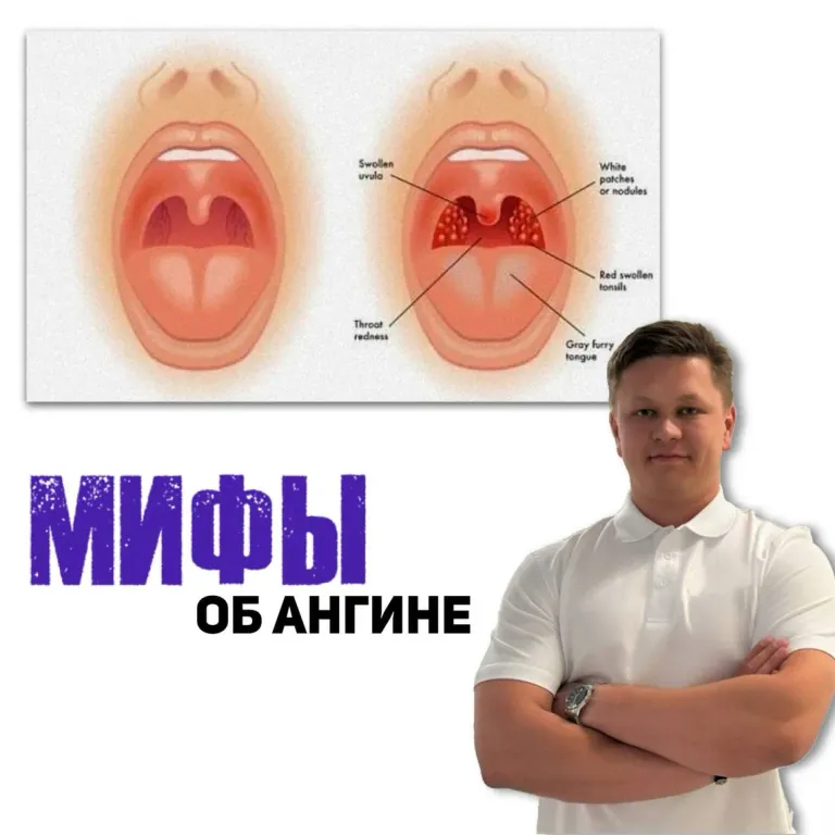 При ангине часто возникают мифы, которые приводят к неверным действиям. Давайте развенчаем самые распространённые: