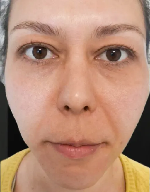 Botulin therapy