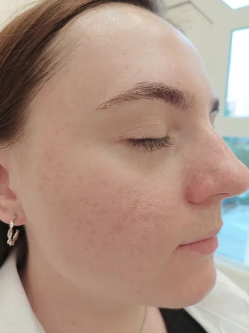 Acne treatment