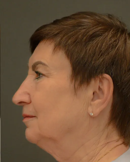 Endoscopic facelift