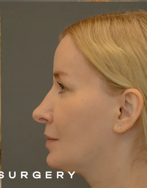 Endoscopic Suspension of the Upper Two Thirds of the Face with Deep Detachment DMAS