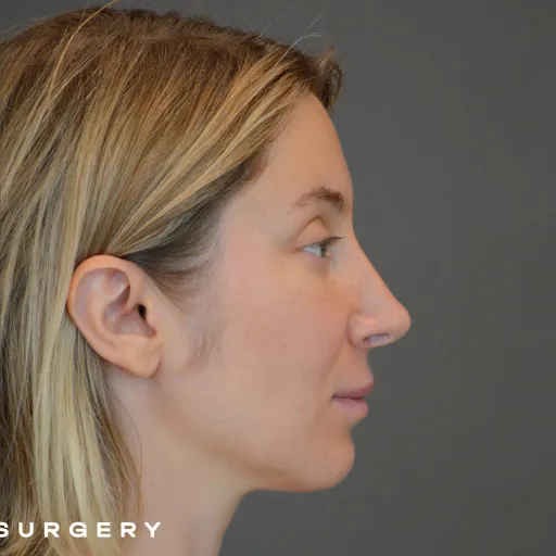 Secondary rhinoplasty