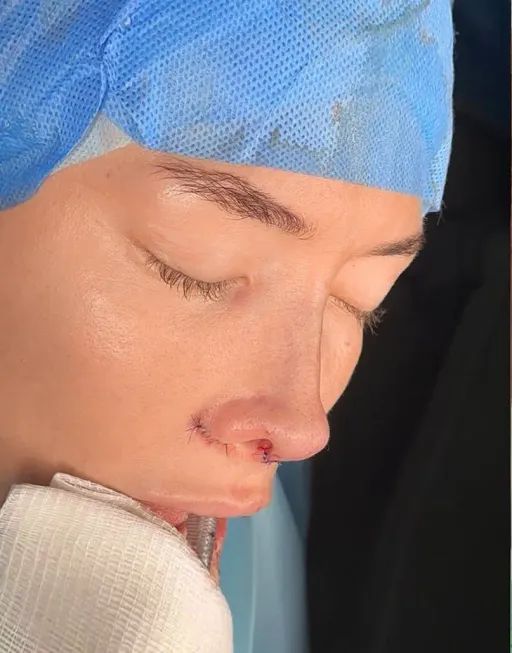 Rhinoseptoplasty
