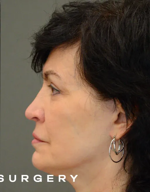 Endoscopic suspension of the middle third of the face with expanded detachment SMAS