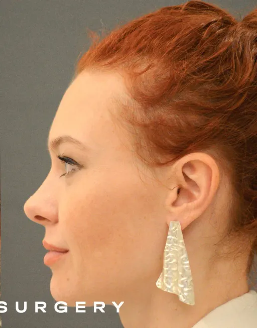 Endoscopic Suspension of the Upper Two Thirds of the Face with Deep Detachment DMAS