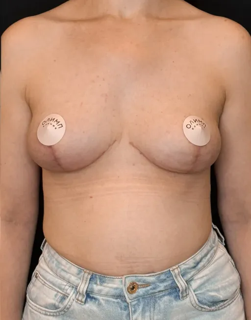 Breast lift (mastopexy)