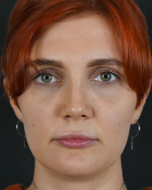 Rhinoplasty
