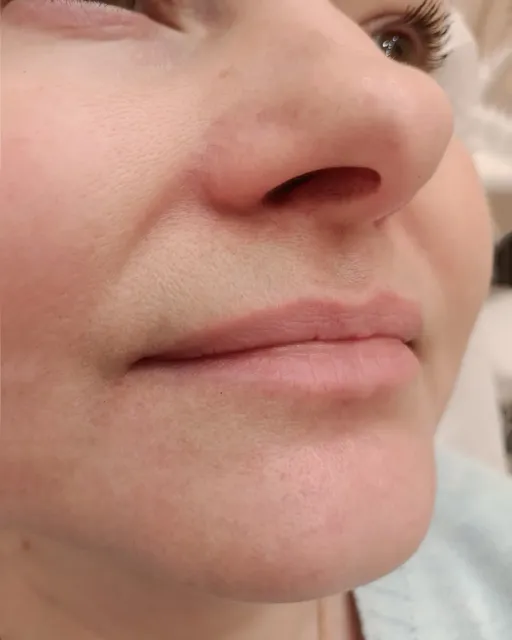 Acne treatment
