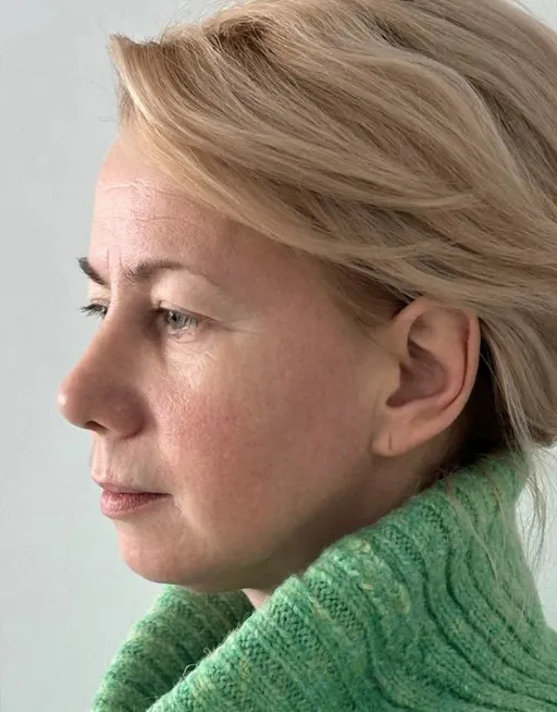 Rhinoseptoplasty