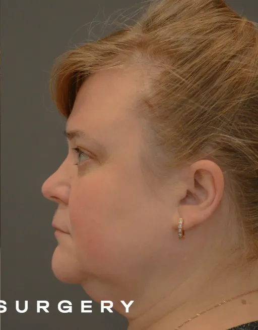 Endoscopic upper third face suspension