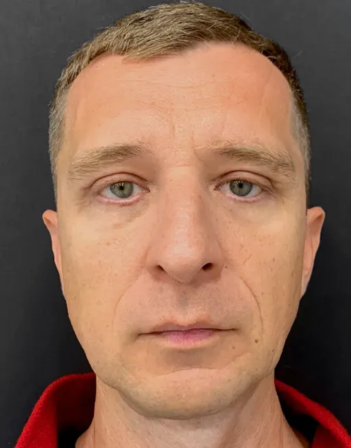 Blefaroplasty