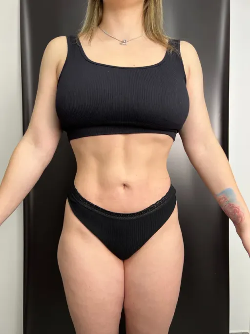 Liposculpture