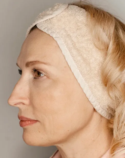 Contouring of the face with Radiesse filler