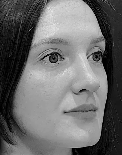 Rhinoplasty