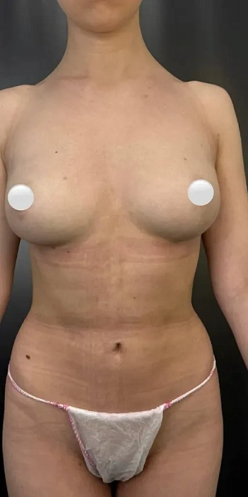 Lipofilling