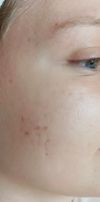 Acne treatment
