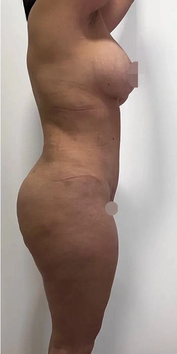 Liposculpture