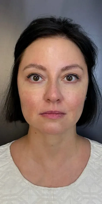 Blefaroplasty