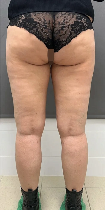 Liposuction