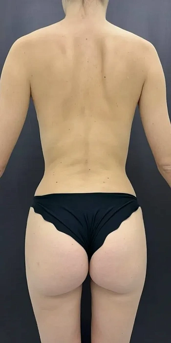 Liposculpture