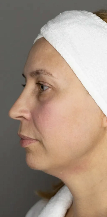 7D-rejuvenation Thermolifting Oligio