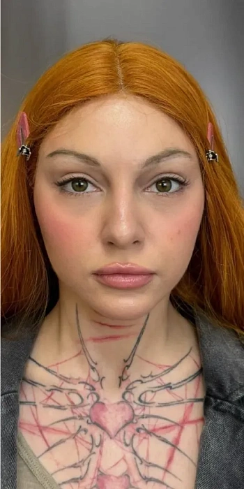 Blefaroplasty