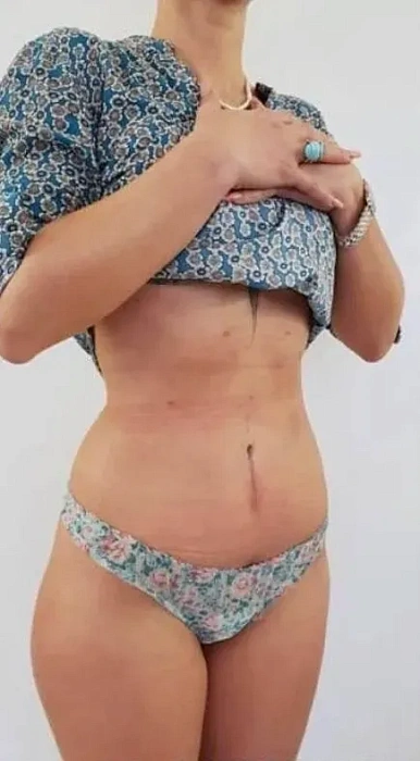Abdominoplasty